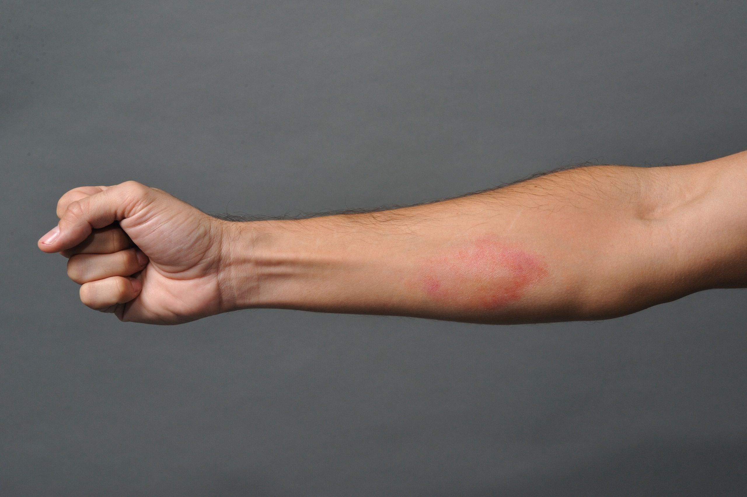 2nd Degree Burn Trauma Tattoo - Image 2