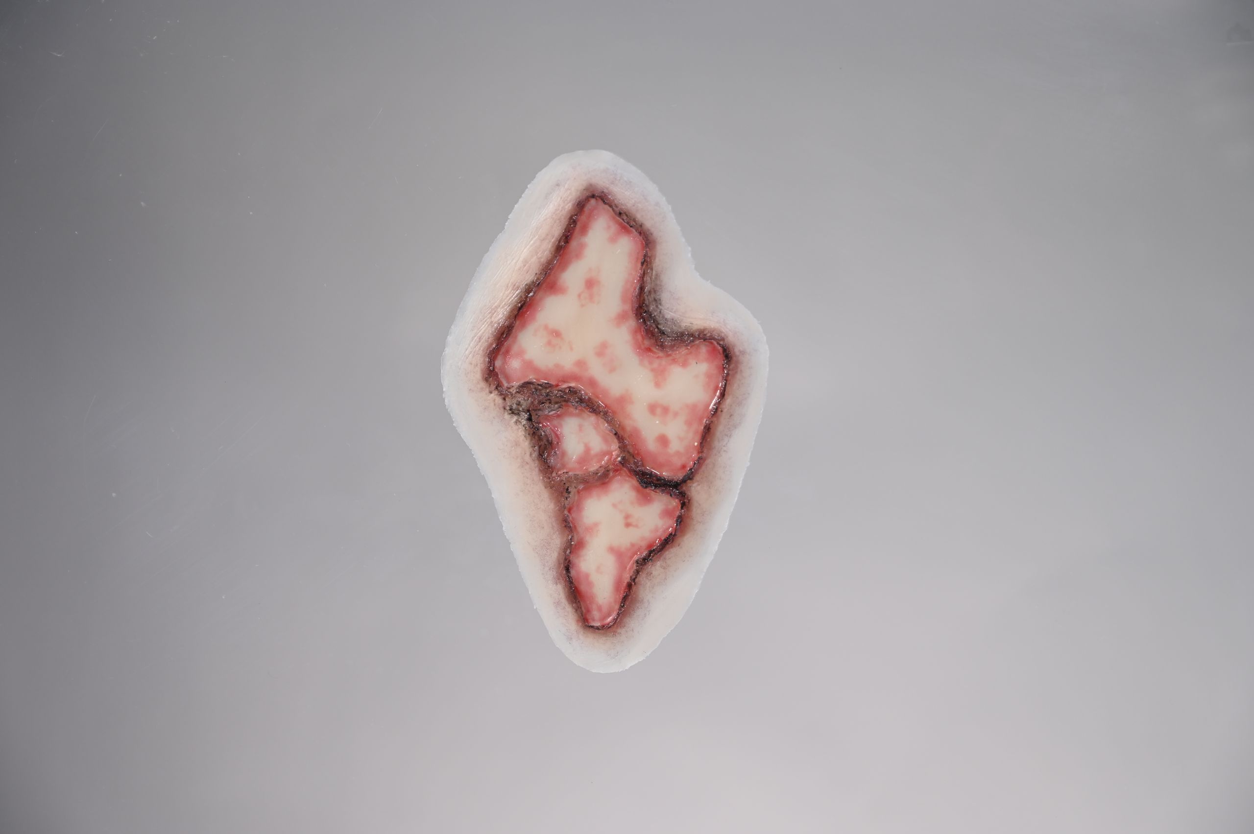 Third Degree Burn - Image 2