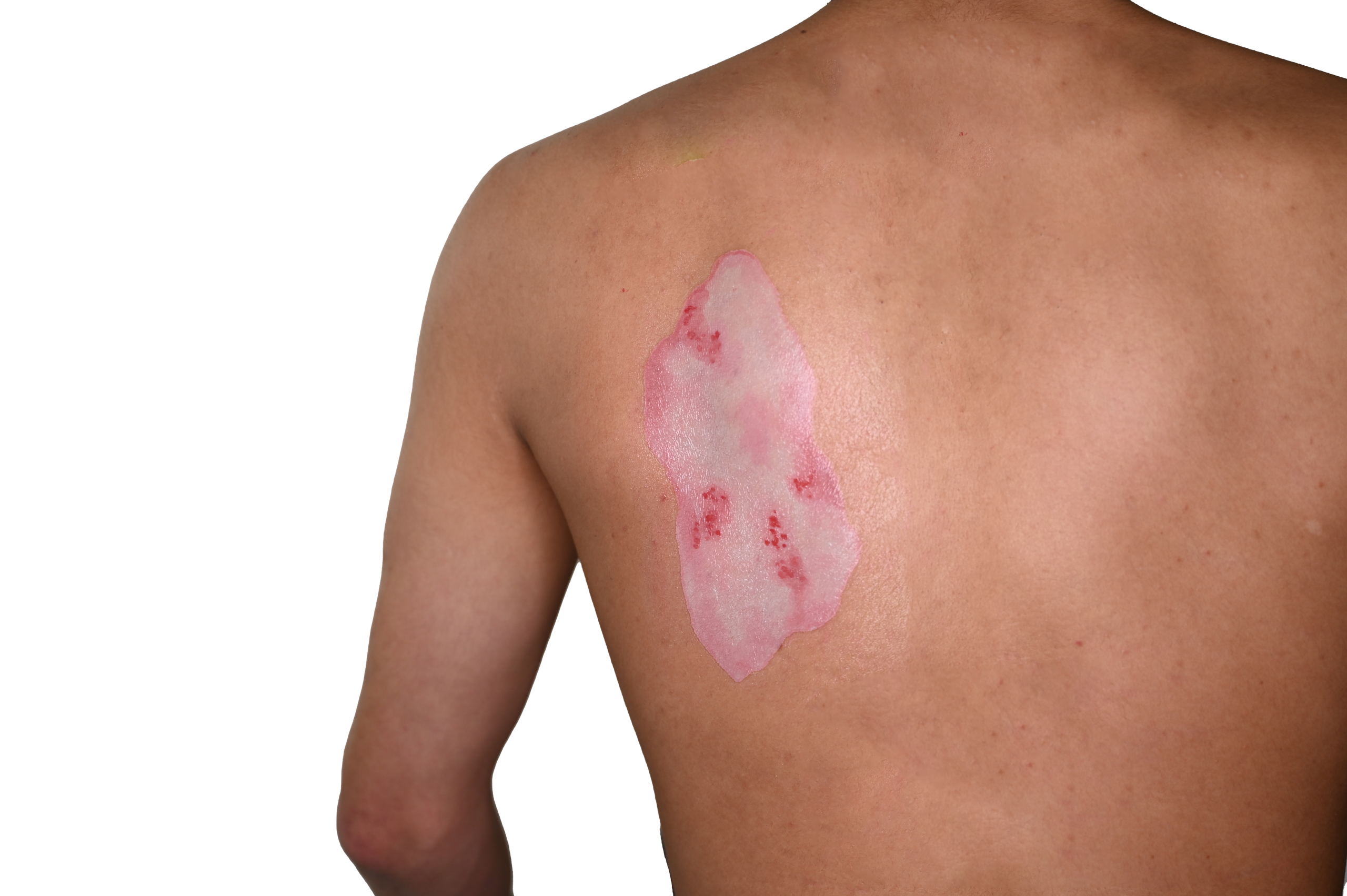 2nd Degree Burn Trauma Tattoo - Image 5