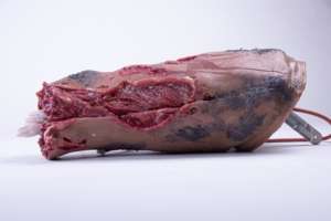 SIMETRI Leg Amputation Moulage product