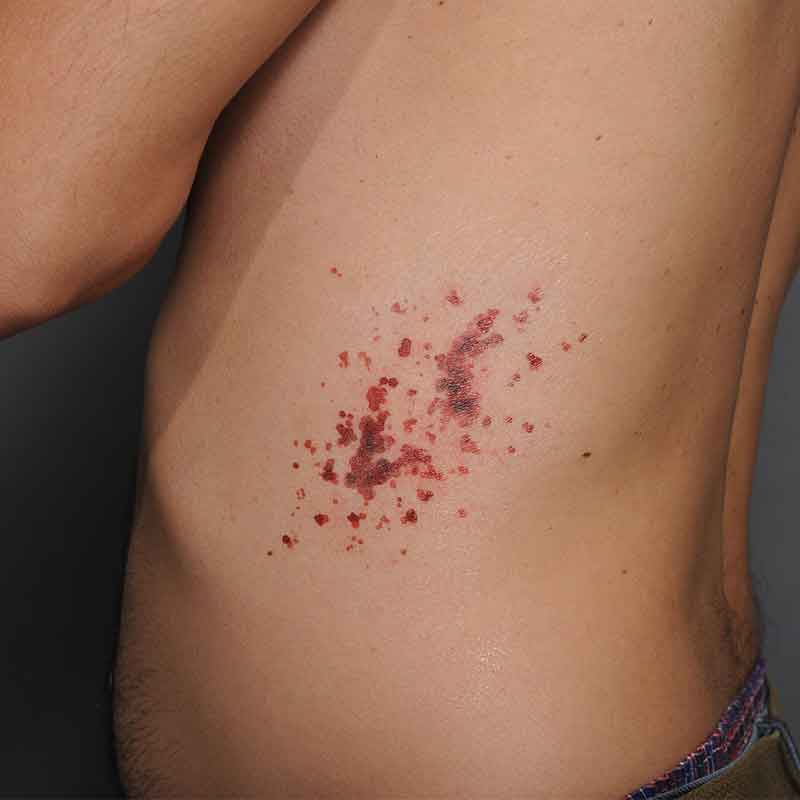 Petechia - Large - Image 2