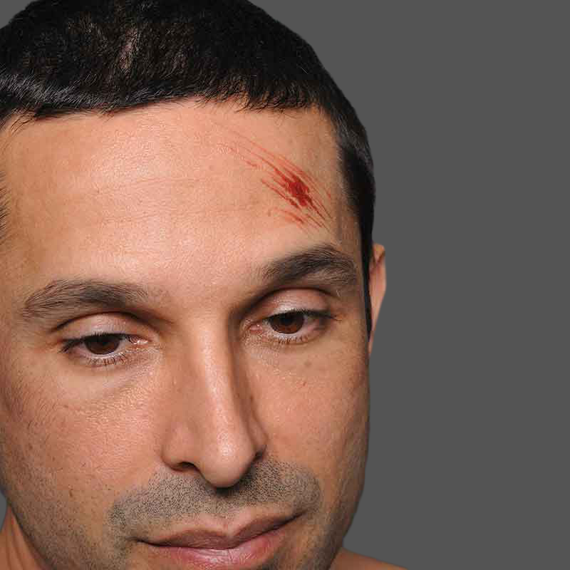 Abrasion - Trauma Tattoo