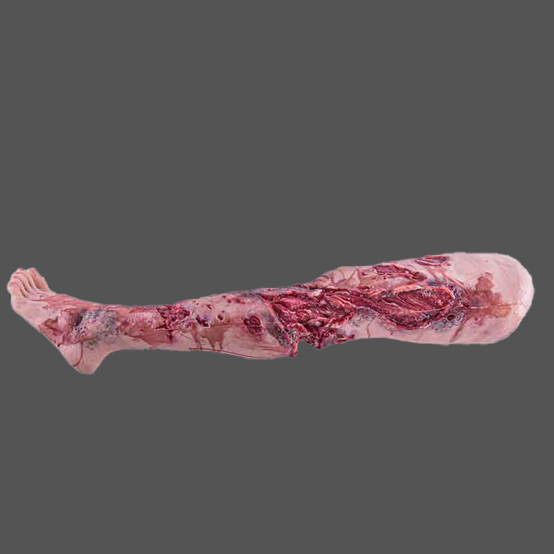 Incomplete Leg Amputation - Left Without Core